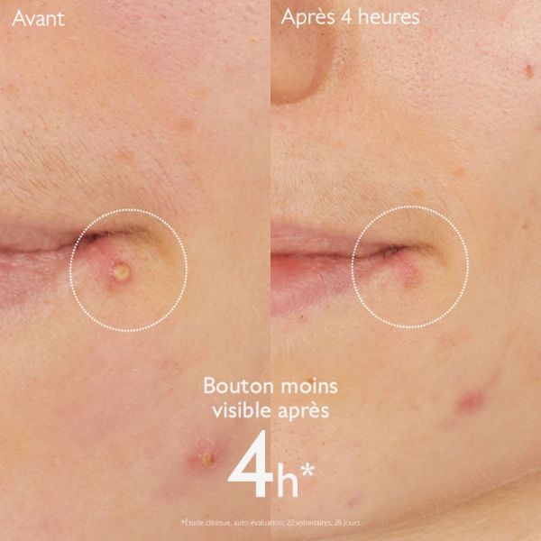 Vinopure Stop Boutons Salicylique 15 ml